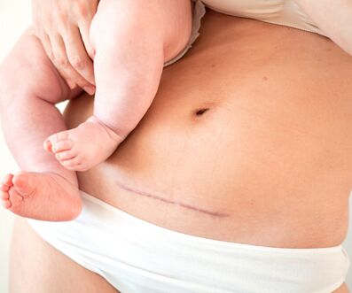 Reducing Surgical Site Infecton in Cesarean Sections